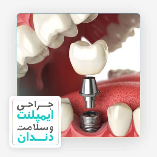 جراحی ایمپلنت و سلامت دندان - دکتر دندان پزشک مهدی سمیعی