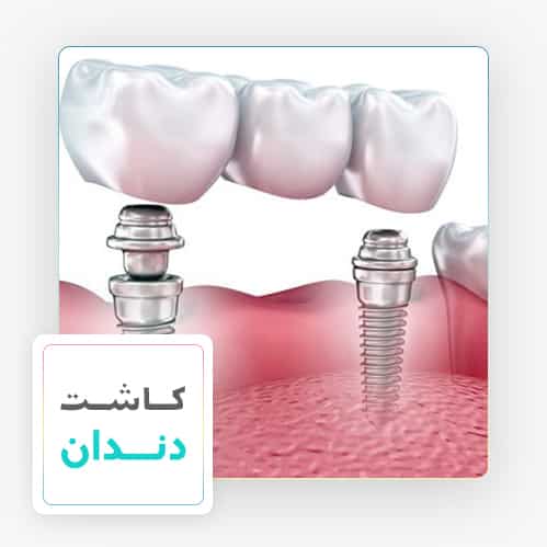 کاشت دندان - دکتر دندانپزشک مهدی سمیعی