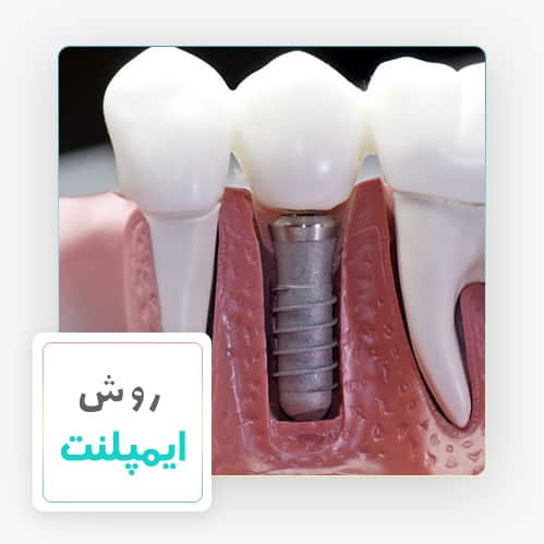 مراحل کاشت دندان ایمپلنت - دکتر دندانپزشک مهدی سمیعی