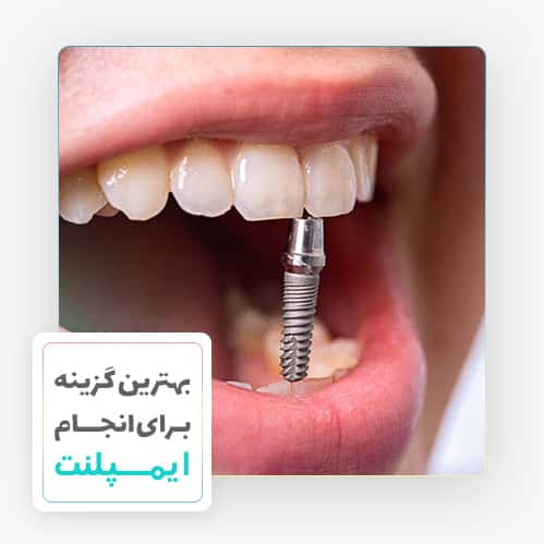 کاشت دندان ایمپلنت - دکتر مهدی سمیعی